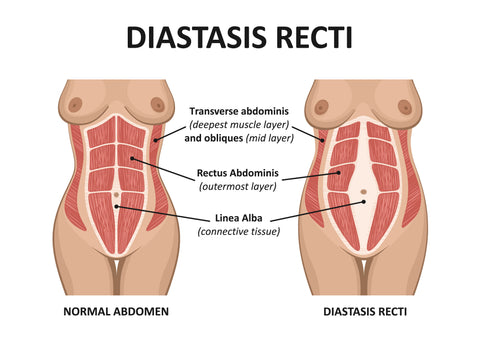 Diastasis Rehab - Yes, most definitely! Especially, if it is an umbilical  hernia. An umbilical hernia is a side effect of diastasis recti. Doing the  Tupler Technique® program will strengthen your weakened