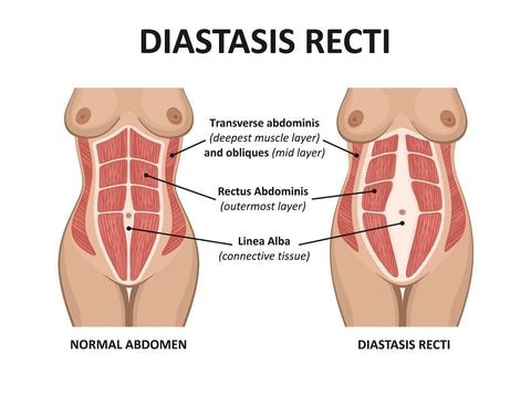 Diastasis Recti Diagram