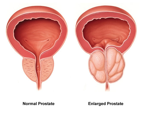 Próstata normal vs agrandada