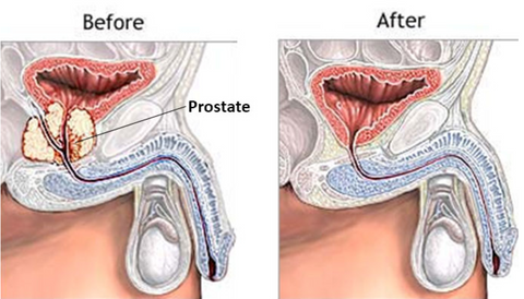 Prostatectomía Radical Antes y Después - Cirugía de Próstata
