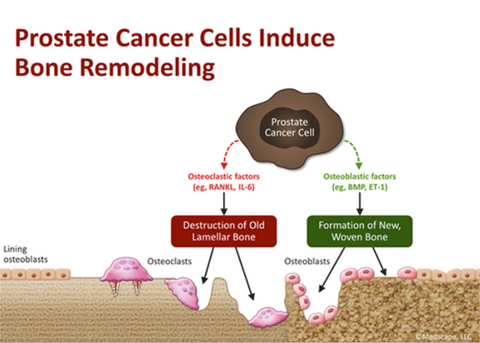 Tratamiento dirigido al hueso | Opciones de tratamiento para el cáncer de próstata localizado - Pacey MedTech Blog