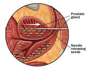 Brachy Therapy | Treatment Options for Localized Prostate Cancer | Pacey MedTech Blog