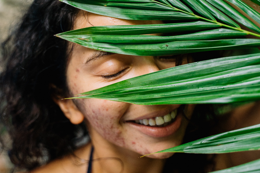 Woman with acne