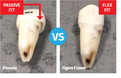Pediatric Dental Crown Fit Comparison