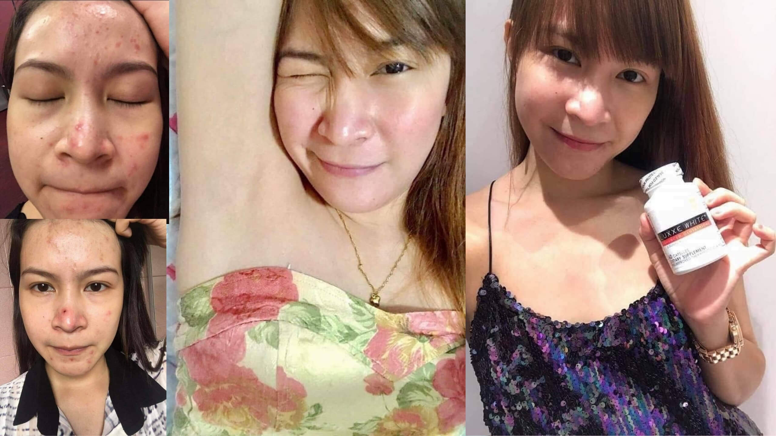 luxxe white before and after pimples and underarm