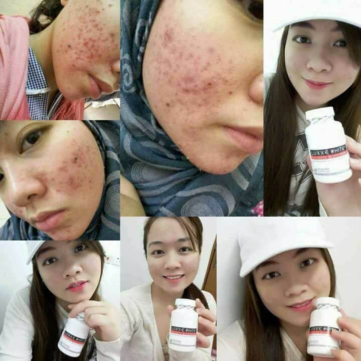 luxxe white before and after female pimples