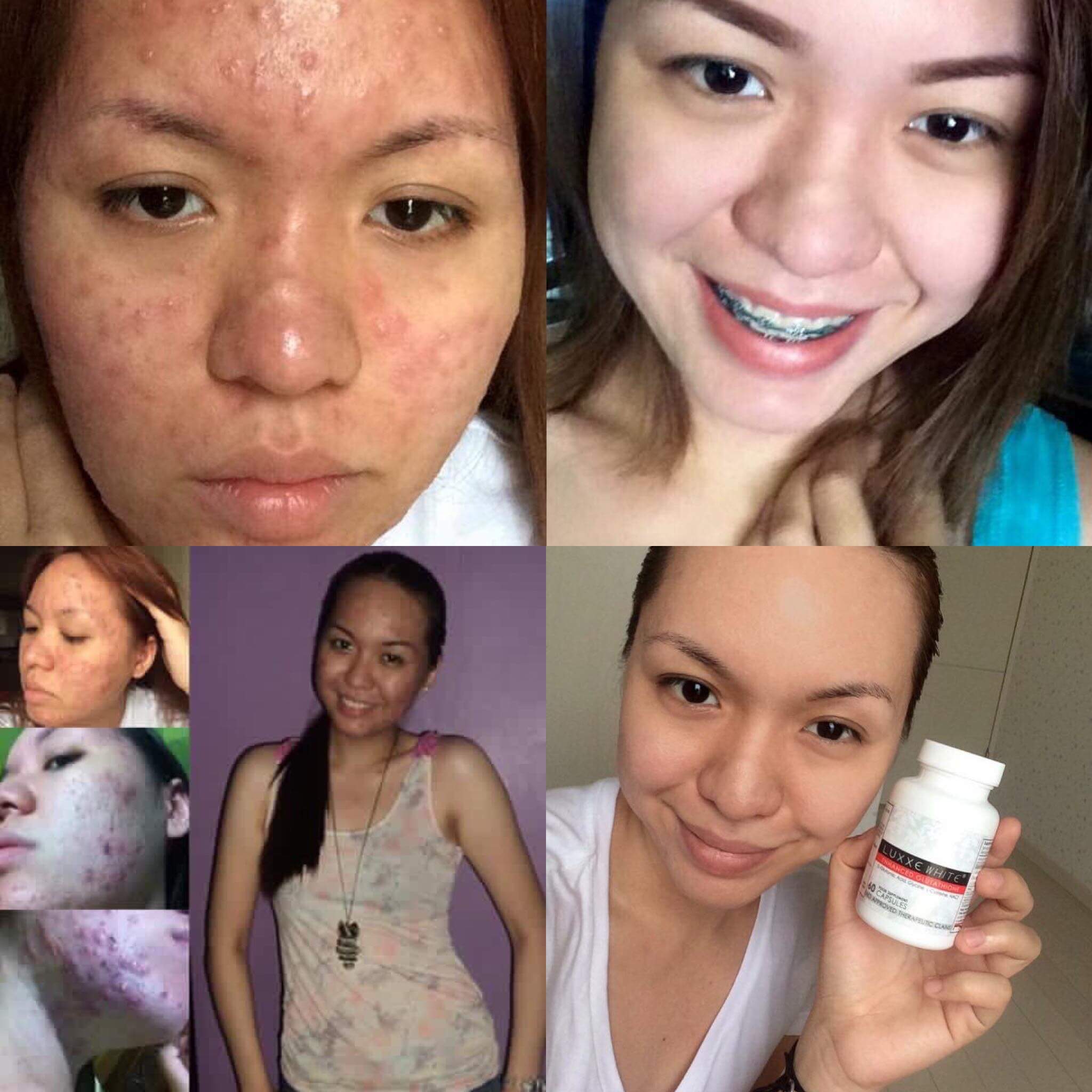 luxxe white glutathione review before and after acne