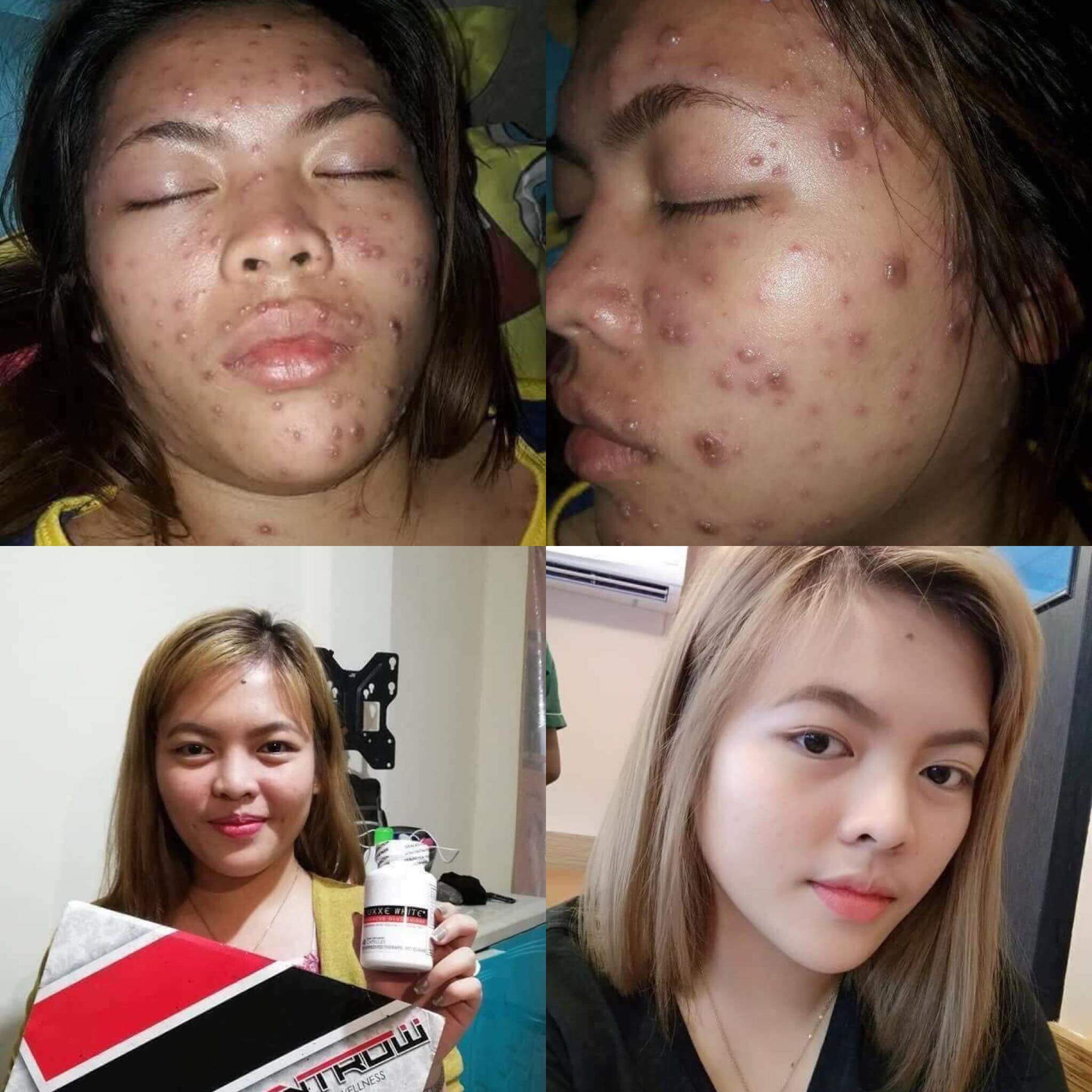 luxxe white review testimony pimples