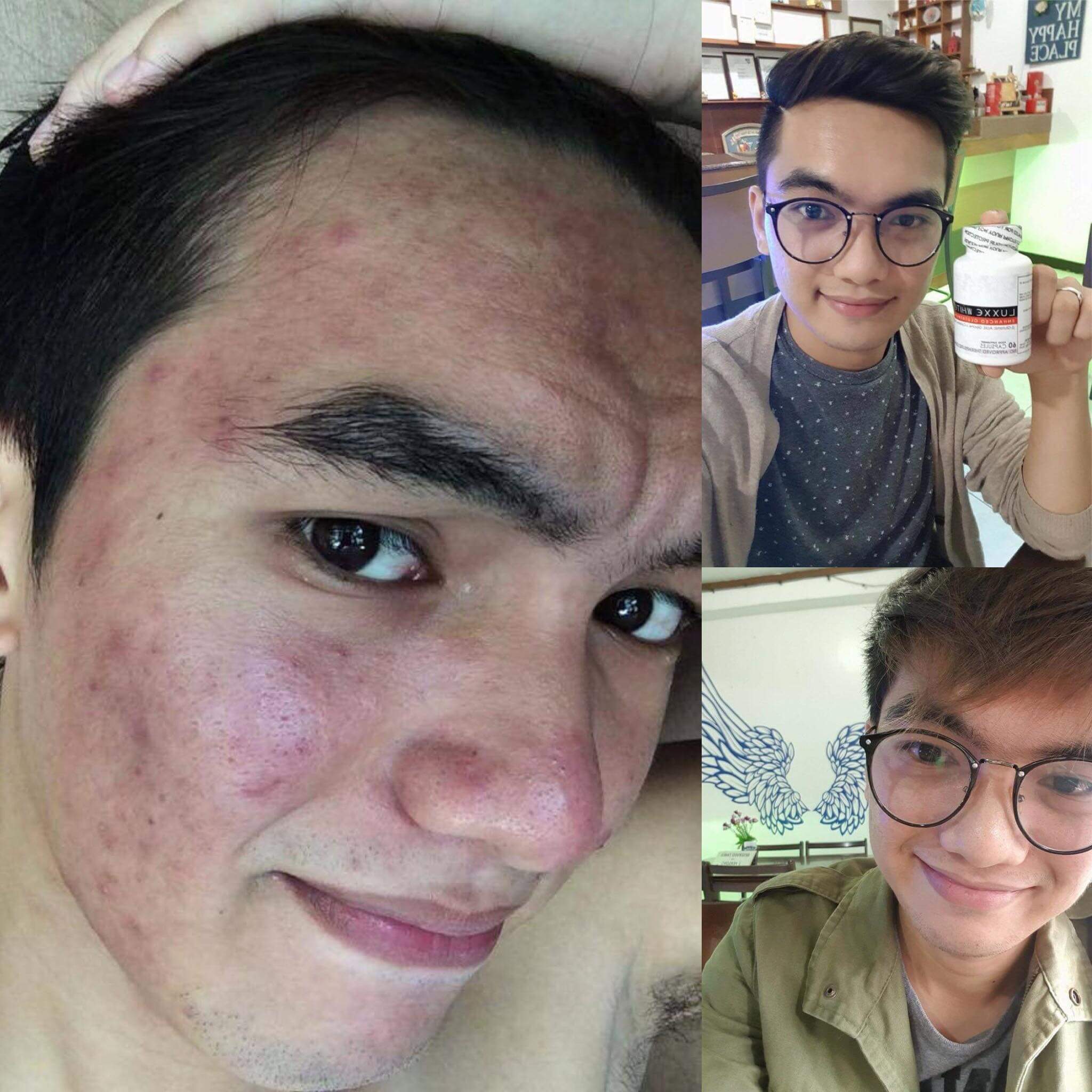 luxxe white user testimony pimples men