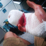 Pongoose blog - Louis hand injury image