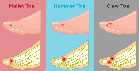 Hammer Toes: Everything You Need to Know - Orthoquest