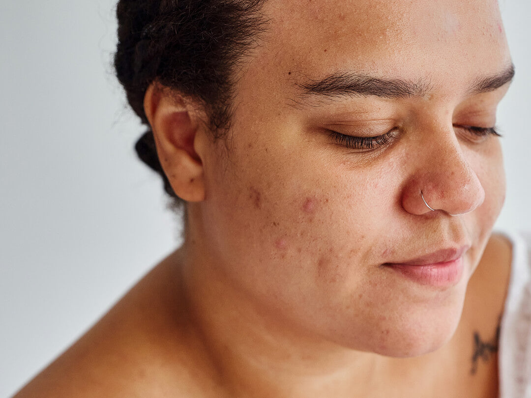 Verstopfte Poren entfernen | Five Skincare