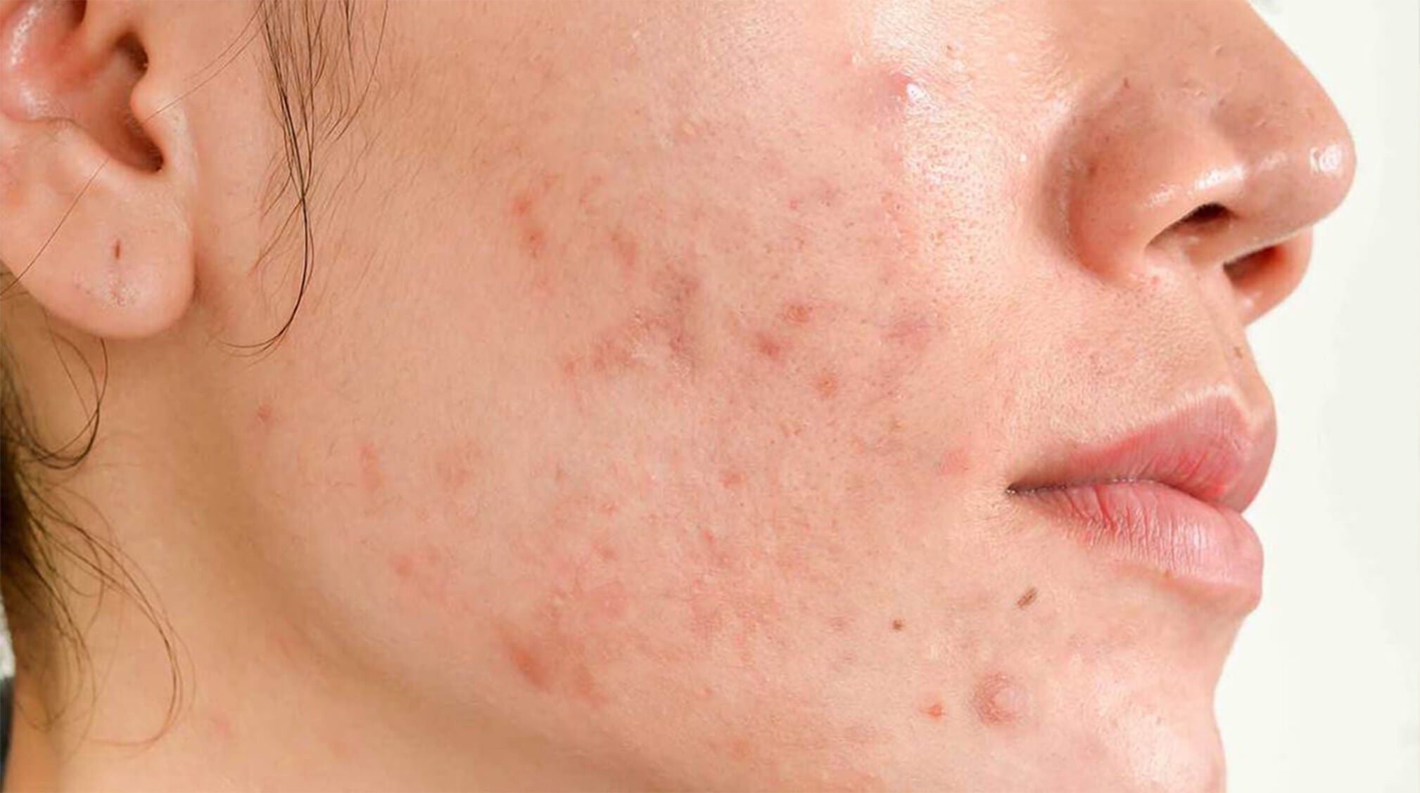 What Causes Hormonal Acne and How To Get Rid of it | Hero Cosmetics