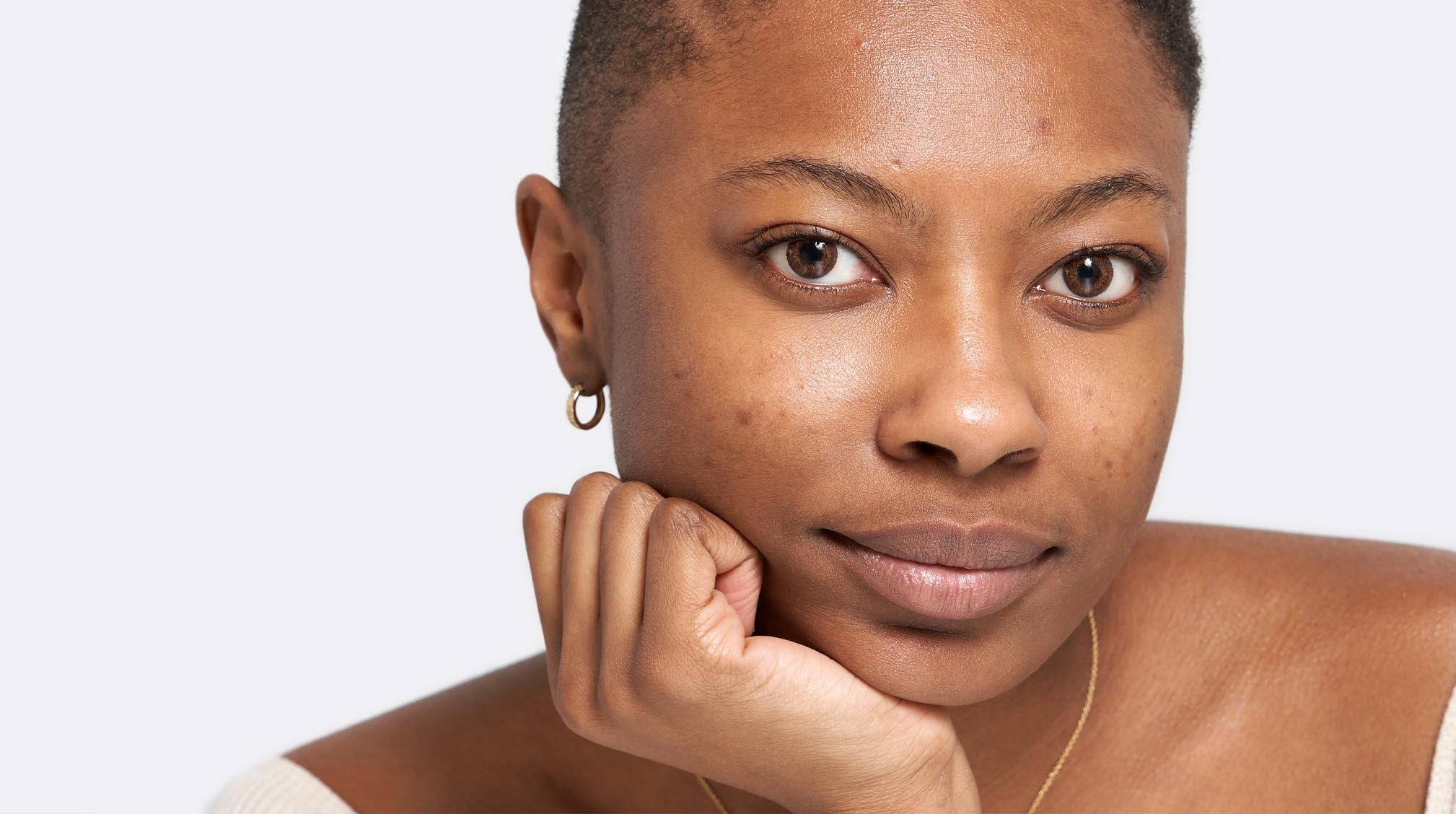 4 Derm Recommended Tips to Treat Hyperpigmentation on 