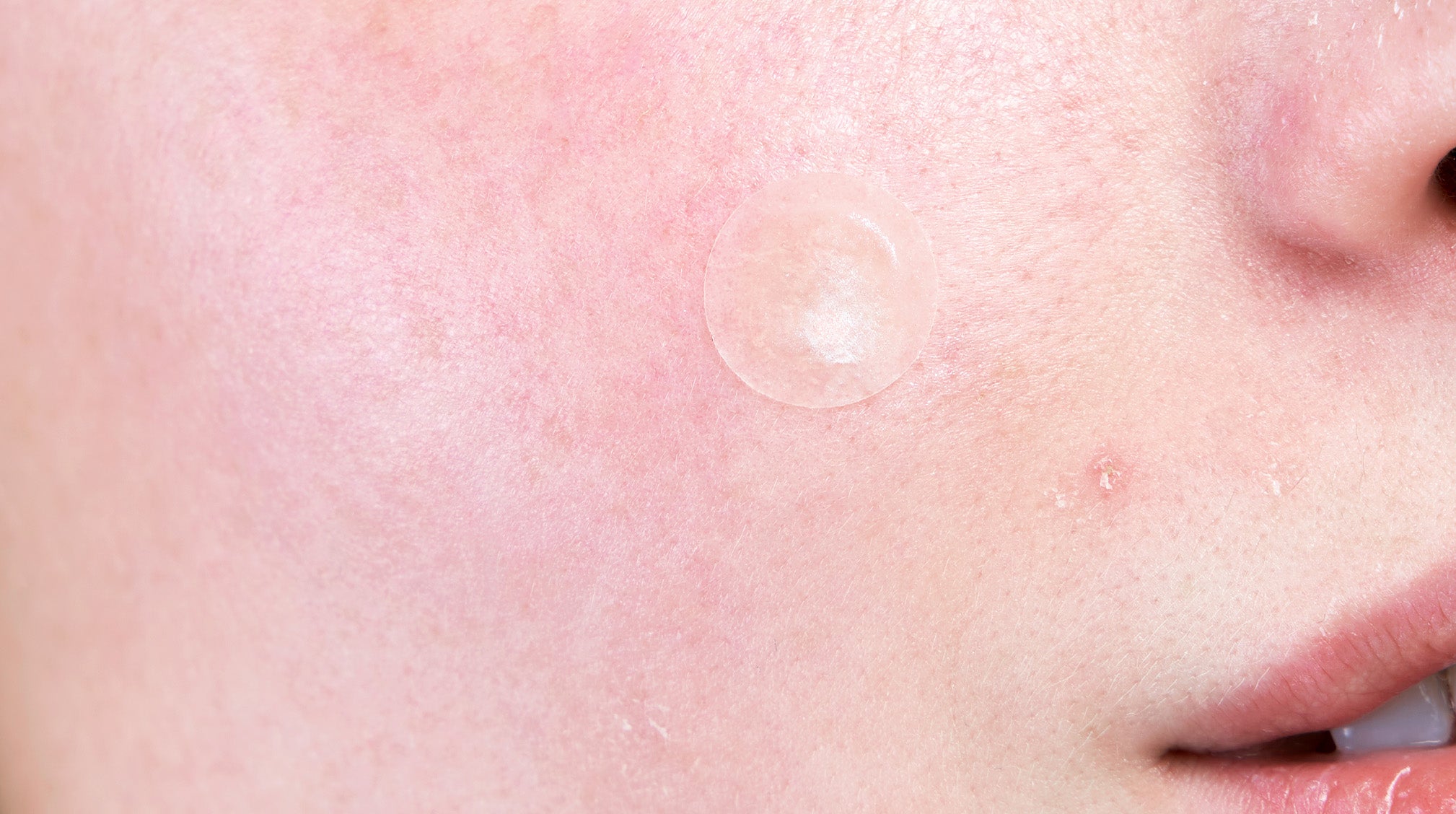 photos of hymenal skin tags