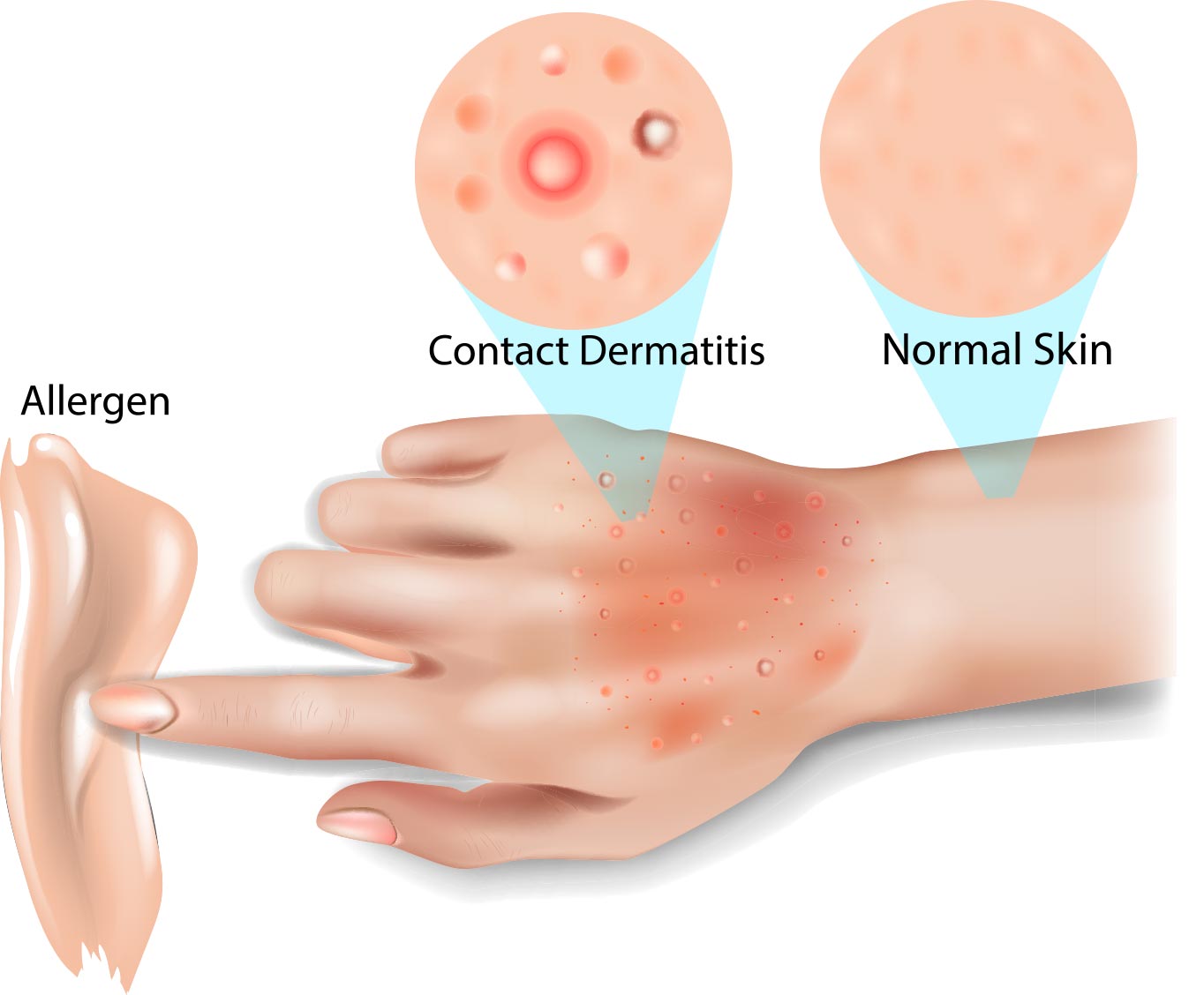 Skin Contact Dermatitis, Allergic contact dermatitis, Irritant contact dermatitis, Phototoxic dermatitis