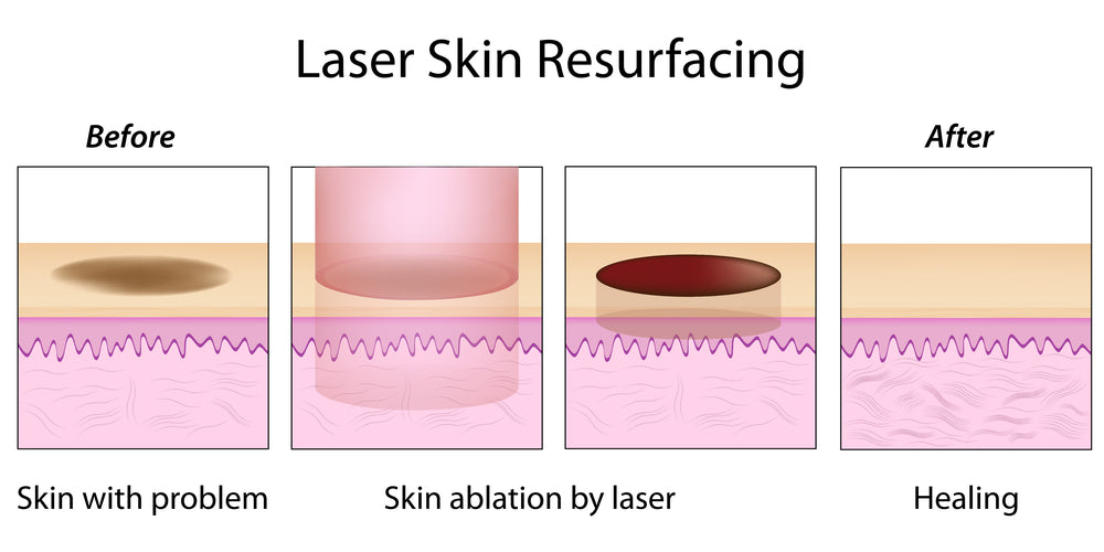 Laser resurfacing graphic