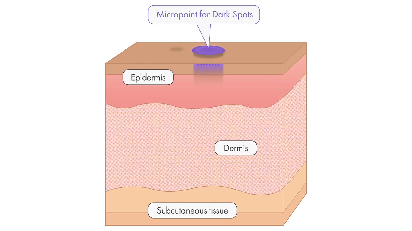 Micropoint for Dark Spots applied to hyperpigmentation spot