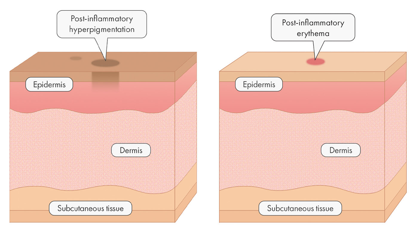 Post-inflammatory Hyperpigmentation (PIH) vs Post-inflammatory Erythema (PIE)