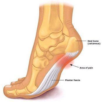 Plantar Fasciitis Therapy Wrap