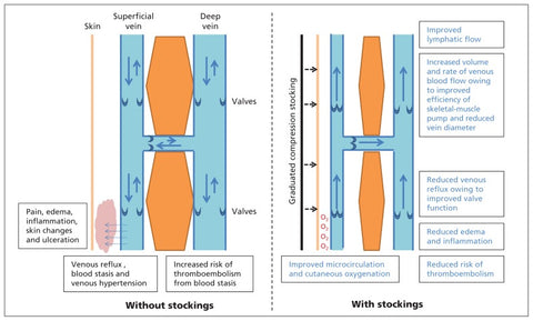 Mechanisms of action of graduated compression stockings or socks - source: Canadian Medical Association Journal