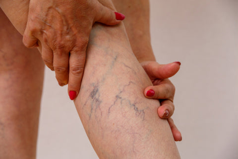 Hands on leg with varicose veins