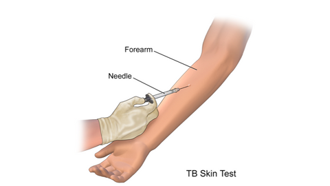 tb skin test