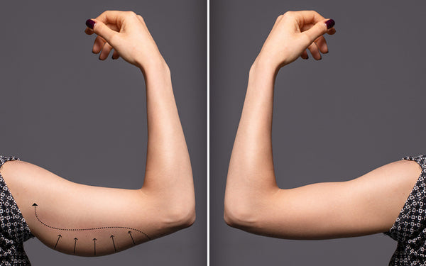 Benefits Of Alternatives To Arm Lift Surgery