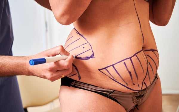 Common Areas For Liposuction