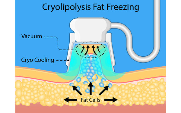 Fat Freezing (Cryolipolysis) Procedure