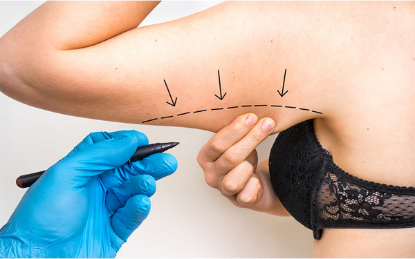 Preparation Of Arm Liposcution Recovery