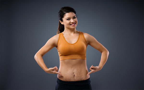Post-Liposuction Scar Care And Recovery