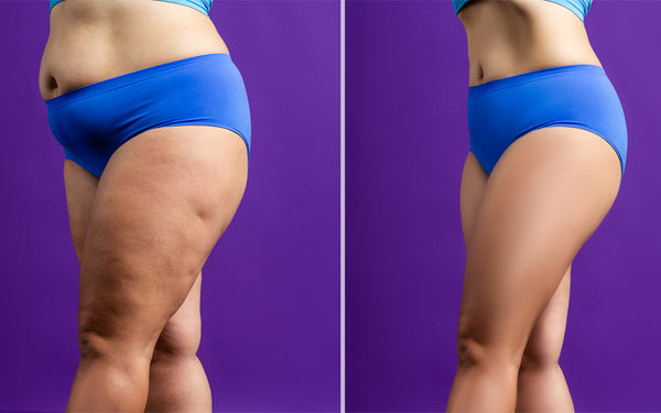 Potential Risks And Varied Results Of Thigh Liposuction