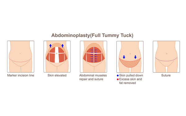 The Process For A Tummy Tuck