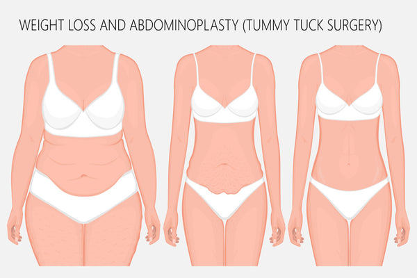 The Tummy Tuck Procedure