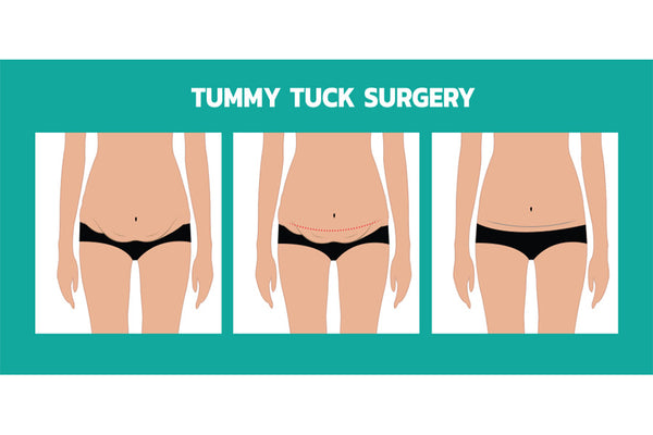 Tummy Tuck Treatment Areas