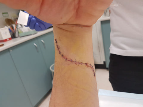 lazy s incision fcr tendon