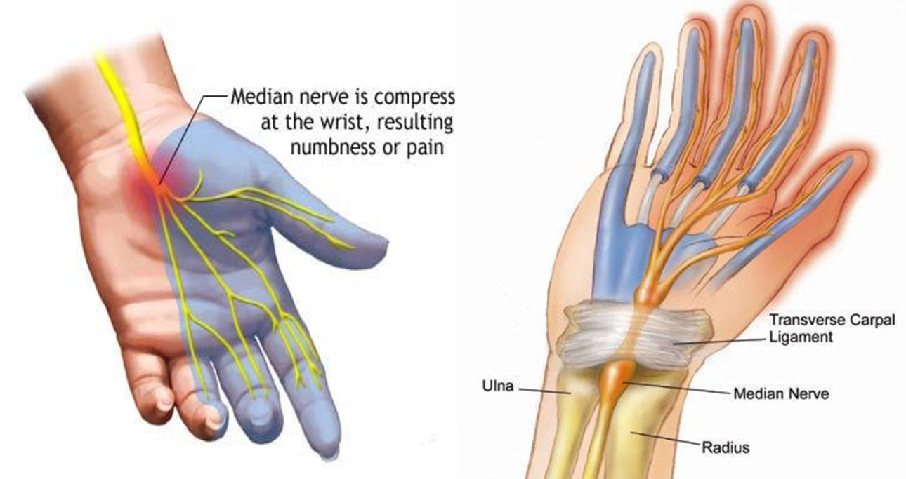 Braces & Splints for Carpal Tunnel