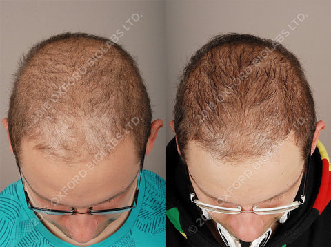Diffuse Hair Thinning in Man
