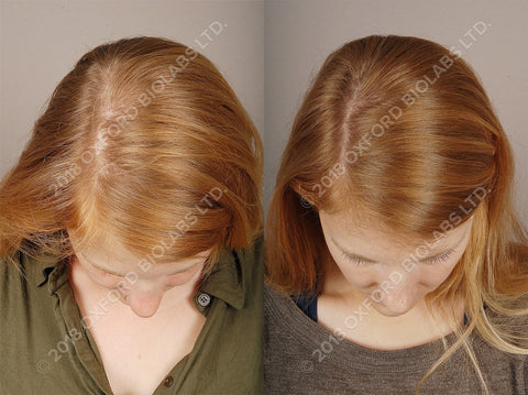 Hair Loss in Woman