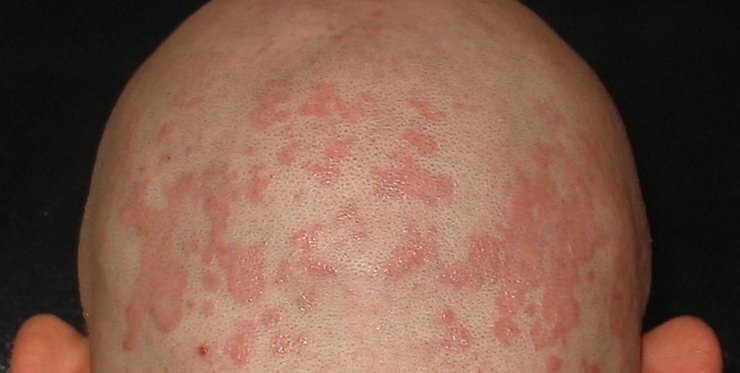 Seborrheic Dermatitis Hair Loss