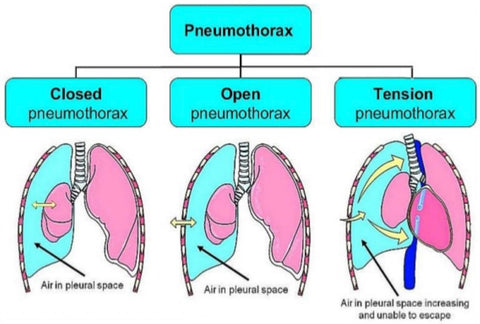 Image from: https://www.orthobullets.com/knee-and-sports/3122/pulmonary-conditions-in-athletes