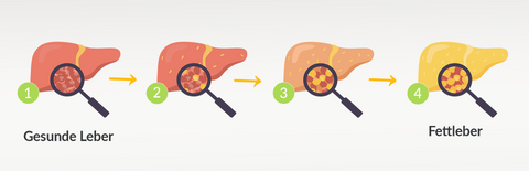 Fettleber Symptome Ursachen: Infografik Stadien einer Fettleber-Erkrankung