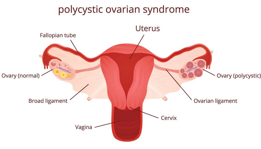 diet pcos