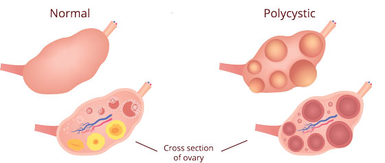 PCOS - polycystic ovaries