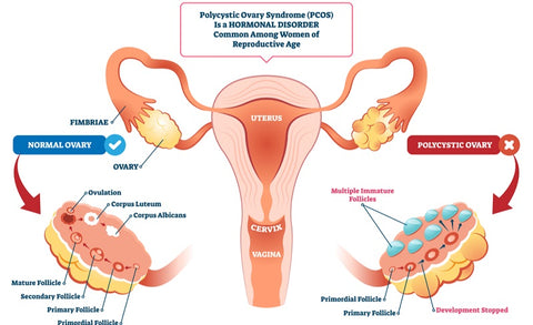 polycystic ovary vs normal ovary