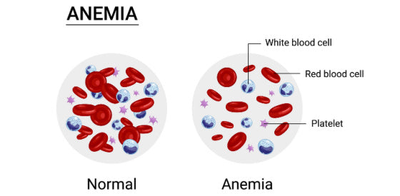 anemia blood cells