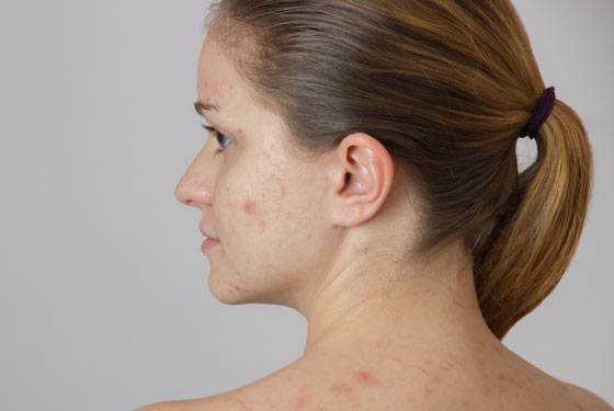 Adult Acne how to treat