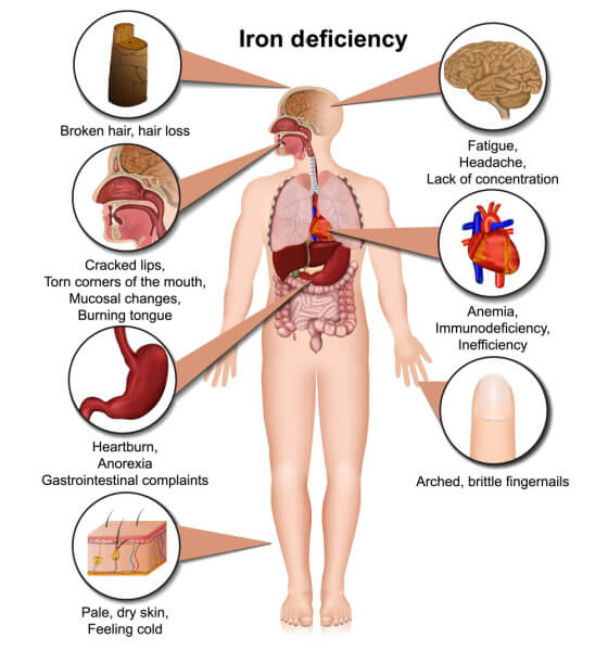 iron deficiency symptoms