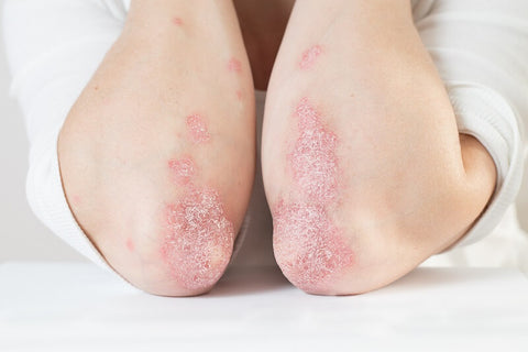 psoriasis on elbows